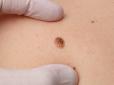 Ваша родимка може бути смертельно небезпечною: Дізнайтеся, на що звертати увагу