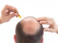 Справа не в генетиці? Вчені назвали фактор, який прискорює облисіння у чоловіків